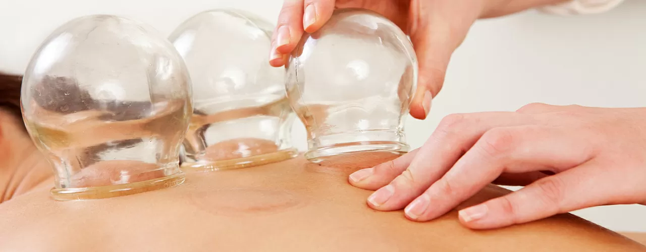 Cupping